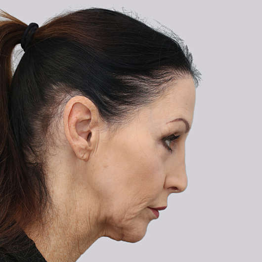 Facelift Adelaide Face & Necklift Specialist Facial Plastic Surgeon