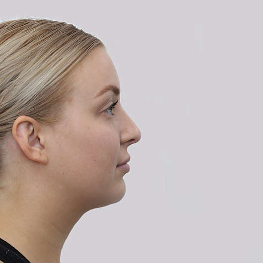 Dr Ha Rhinoplasty Before & After (Female) - Adelaide