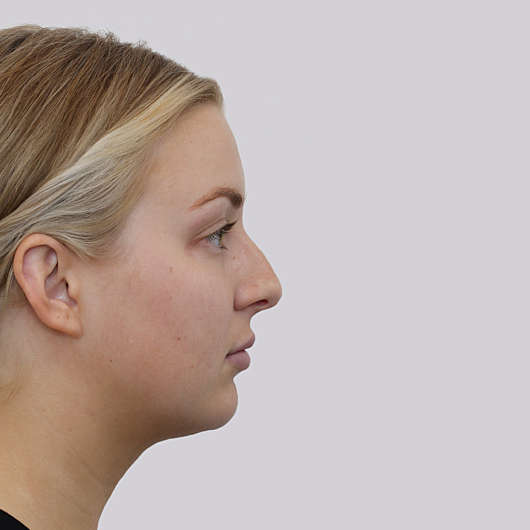 Dr Ha Rhinoplasty Before & After (Female) - Adelaide