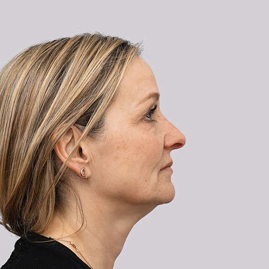 Dr Ha Rhinoplasty Before & After - Adelaide
