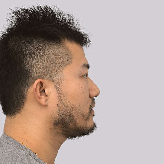 Dr Ha Rhinoplasty Before & After (Male) - Adelaide