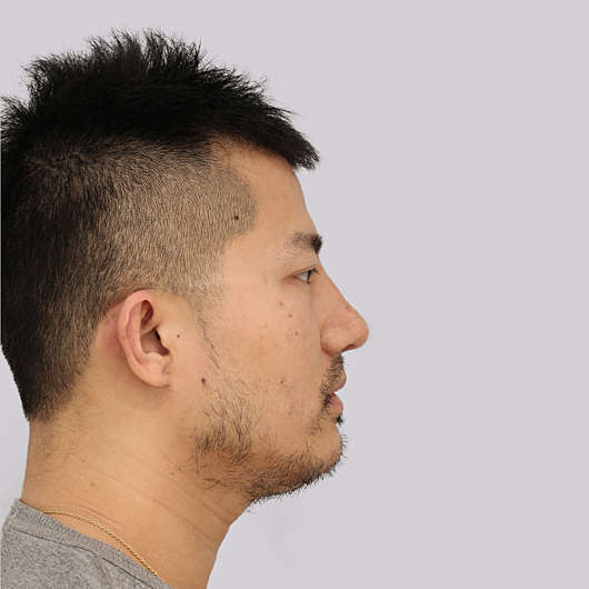 Dr Ha Rhinoplasty Before & After (Male) - Adelaide